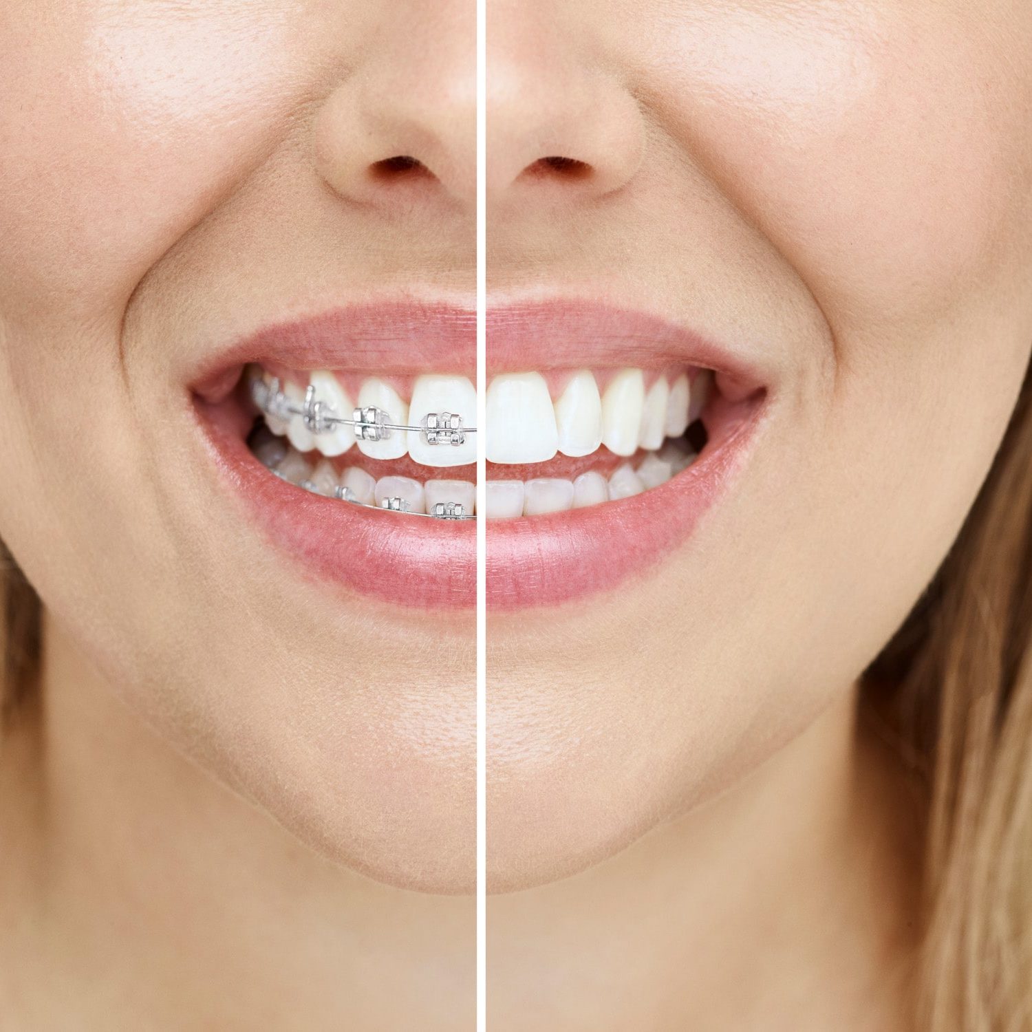 Close-up of a patient's smile showing clear orthodontic aligners | Harwell & Cook Orthodontics