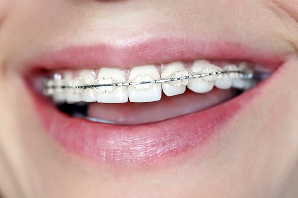 Close-up of teeth with ceramic braces | Harwell & Cook Orthodontics