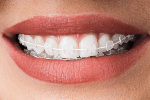 Close-up of teeth with traditional metal braces | Harwell & Cook Orthodontics