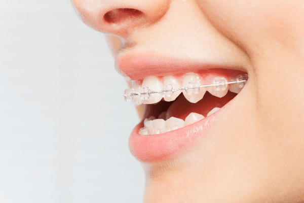 Close-up of teeth with clear ceramic braces | Harwell & Cook Orthodontics